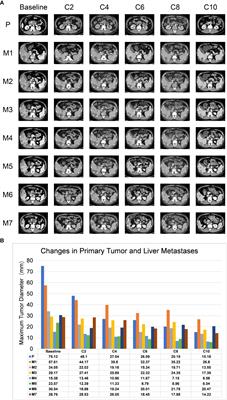 Case Report: Anlotinib combined with PD-1 inhibitor and sequential GA regimen or FOLFIRINOX Chemotherapy in treatment of KRAS G12V mutated pancreatic ductal adenocarcinoma with liver metastasis: A case and literature review